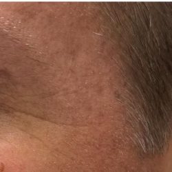 Botox Before & After Patient #1230