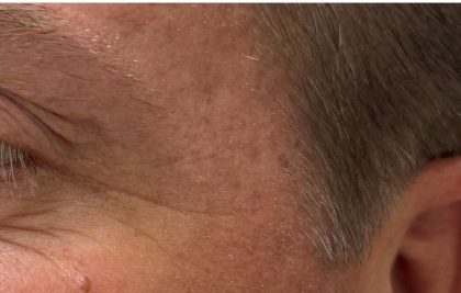 Botox Before & After Patient #1230