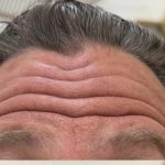 Botox Before & After Patient #1229