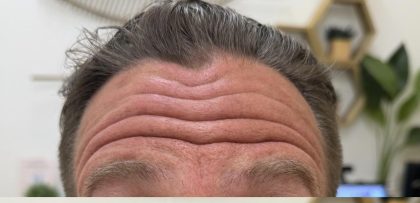 Botox Before & After Patient #1229