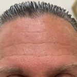 Botox Before & After Patient #1229