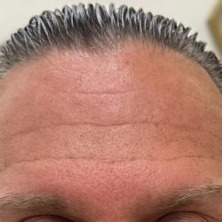 Botox Before & After Patient #1229