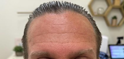 Botox Before & After Patient #1229