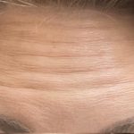 Botox Before & After Patient #1234