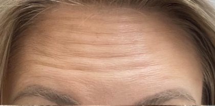 Botox Before & After Patient #1234