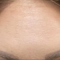 Botox Before & After Patient #1234
