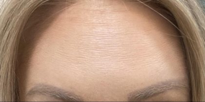 Botox Before & After Patient #1234