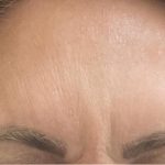 Botox Before & After Patient #1235