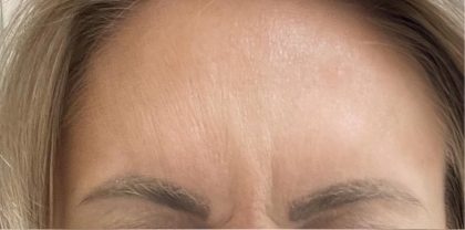 Botox Before & After Patient #1235