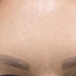 Botox Before & After Patient #1235