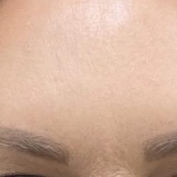 Botox Before & After Patient #1235