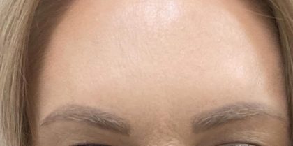 Botox Before & After Patient #1235