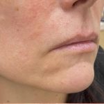 Lip Augmentation Before & After Patient #1221