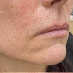 Lip Augmentation Before & After Patient #1221