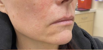 Lip Augmentation Before & After Patient #1221