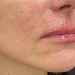Lip Augmentation Before & After Patient #1221