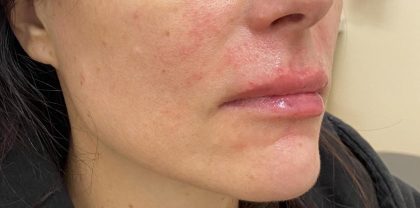 Lip Augmentation Before & After Patient #1221