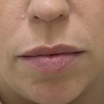 Lip Augmentation Before & After Patient #1228