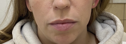 Lip Augmentation Before & After Patient #1228