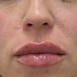 Lip Augmentation Before & After Patient #1228
