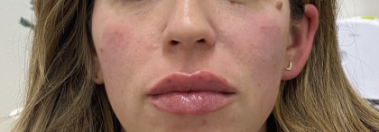 Lip Augmentation Before & After Patient #1228