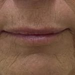 Lip Augmentation Before & After Patient #1226