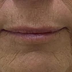 Lip Augmentation Before & After Patient #1226