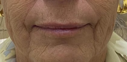 Lip Augmentation Before & After Patient #1226