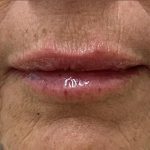 Lip Augmentation Before & After Patient #1226