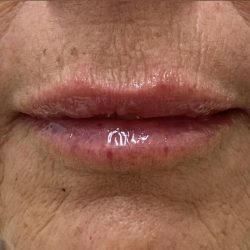 Lip Augmentation Before & After Patient #1226