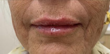 Lip Augmentation Before & After Patient #1226