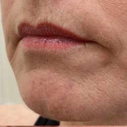 Lip Augmentation Before & After Patient #1231