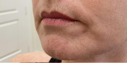 Lip Augmentation Before & After Patient #1231