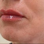 Lip Augmentation Before & After Patient #1231