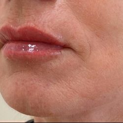 Lip Augmentation Before & After Patient #1231