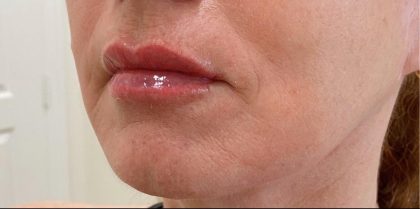 Lip Augmentation Before & After Patient #1231