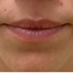Lip Augmentation Before & After Patient #1232