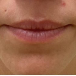 Lip Augmentation Before & After Patient #1232