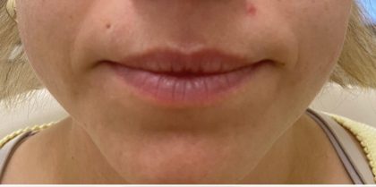 Lip Augmentation Before & After Patient #1232