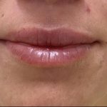 Lip Augmentation Before & After Patient #1232