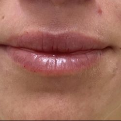 Lip Augmentation Before & After Patient #1232