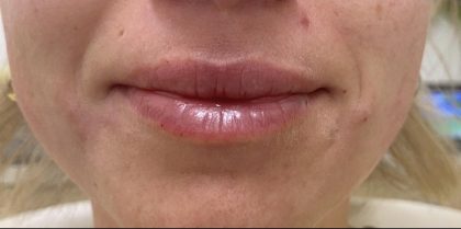 Lip Augmentation Before & After Patient #1232