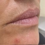 Lip Augmentation Before & After Patient #1236