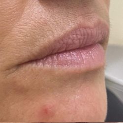 Lip Augmentation Before & After Patient #1236