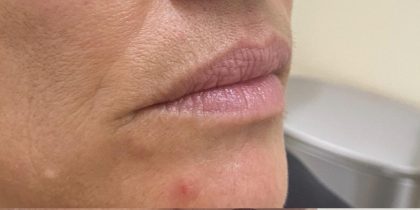 Lip Augmentation Before & After Patient #1236