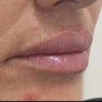 Lip Augmentation Before & After Patient #1236
