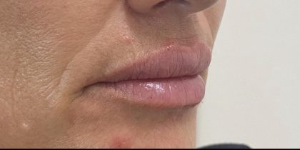 Lip Augmentation Before & After Patient #1236
