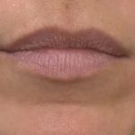 Lip Augmentation Before & After Patient #1238