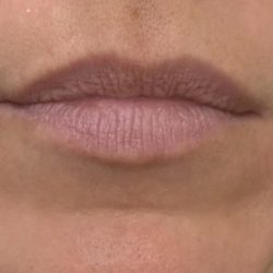 Lip Augmentation Before & After Patient #1238