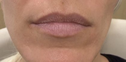 Lip Augmentation Before & After Patient #1238